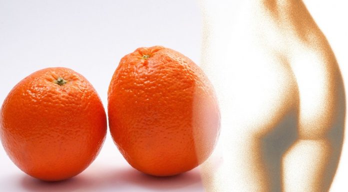 A narancsbőr sok nő életét keseríti meg