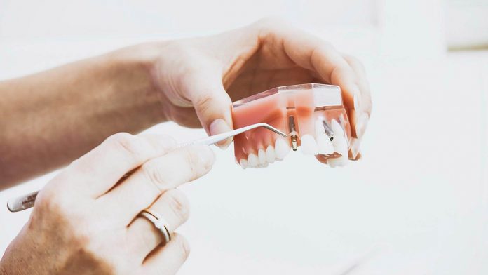 Mi a fogászati implantátumok szerepe?